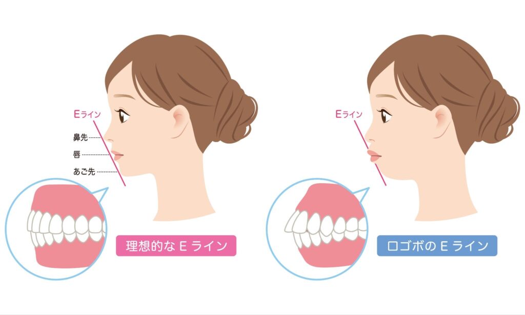 理想的なEラインと口ゴボのEラインのイラスト