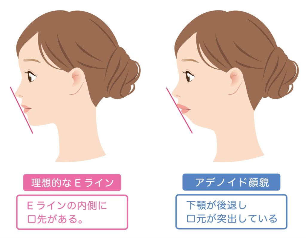 理想的なEラインの横顔とアデノイド顔貌の横顔のイラスト