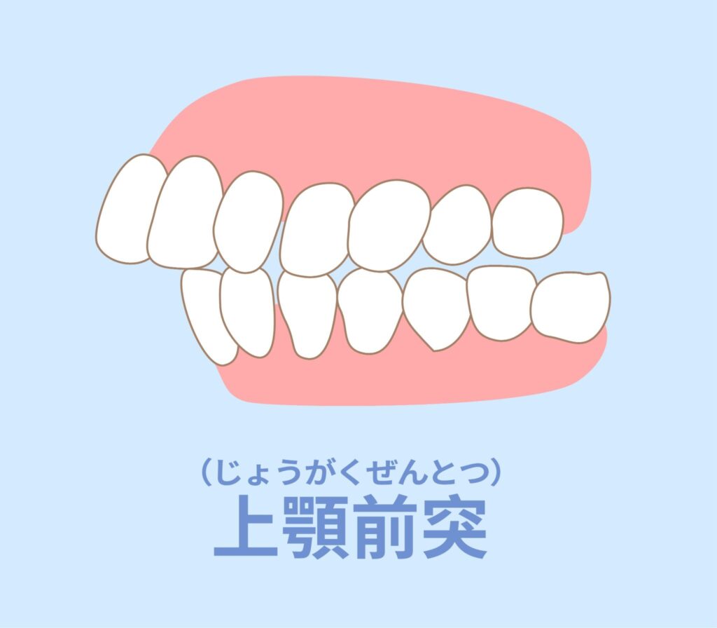 上顎前突（出っ歯）のイラスト
