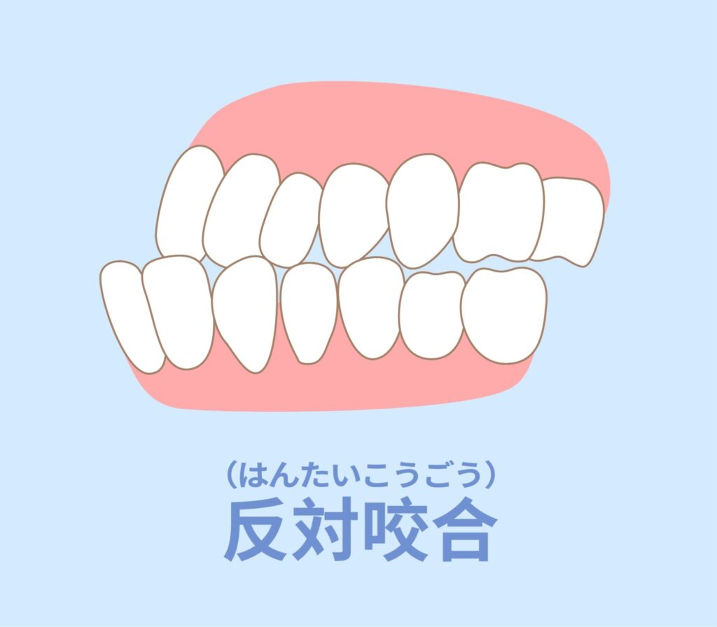 反対咬合（受け口）のイラスト
