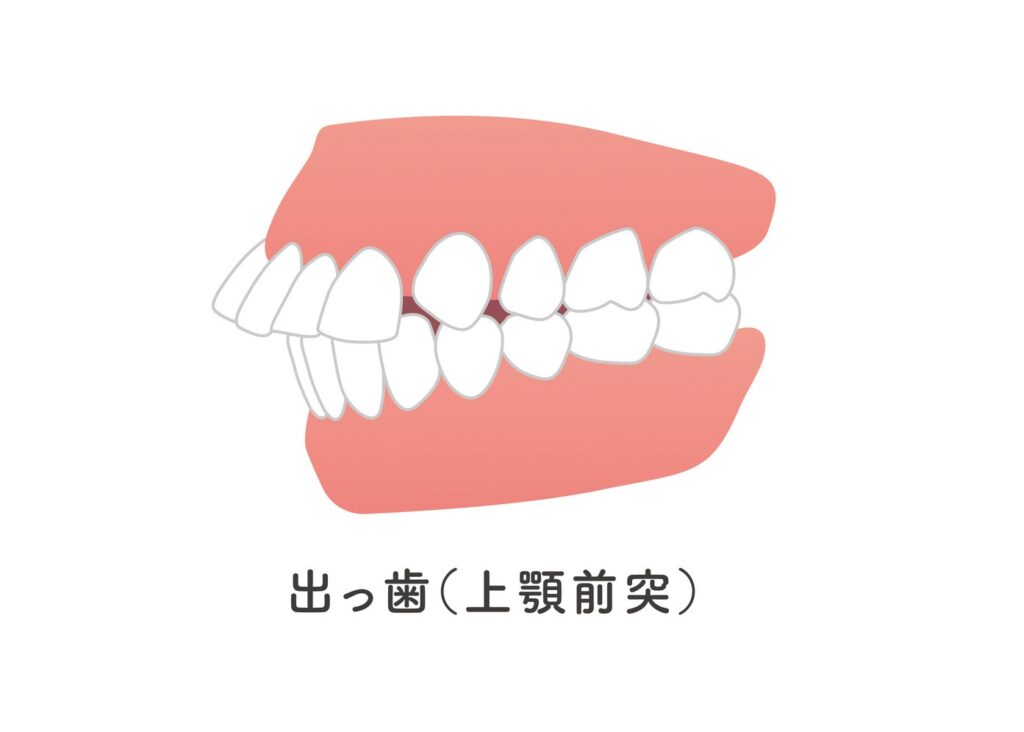 上顎前突（出っ歯）のイラスト