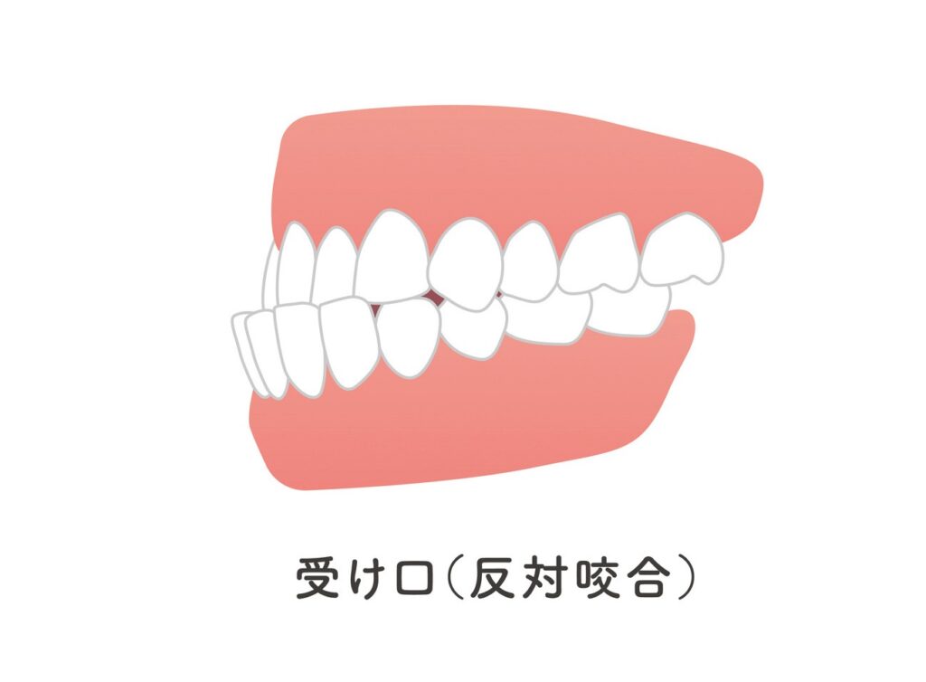 下顎前突（受け口・しゃくれ）のイラスト
