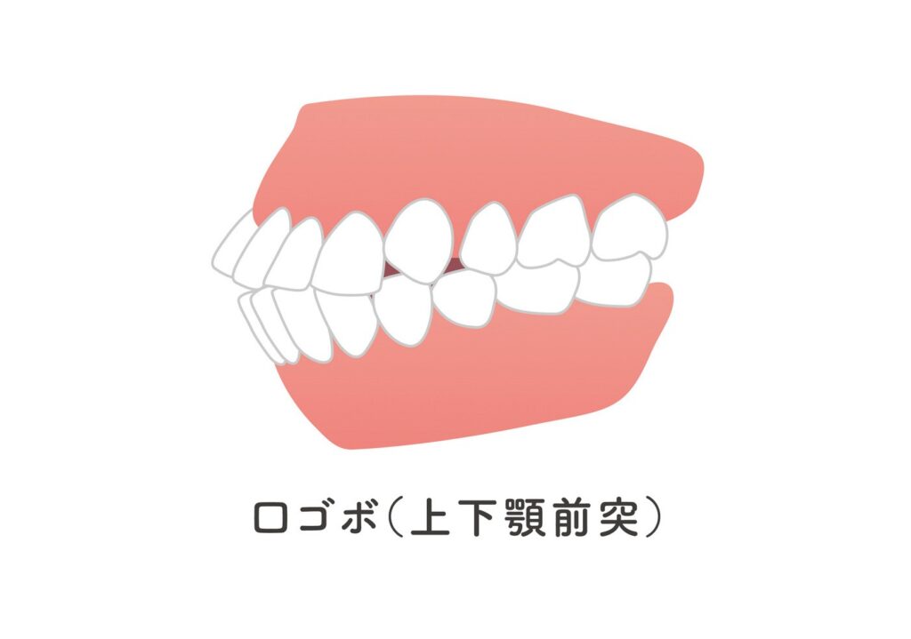 上下顎前突（口ゴボ）のイラスト