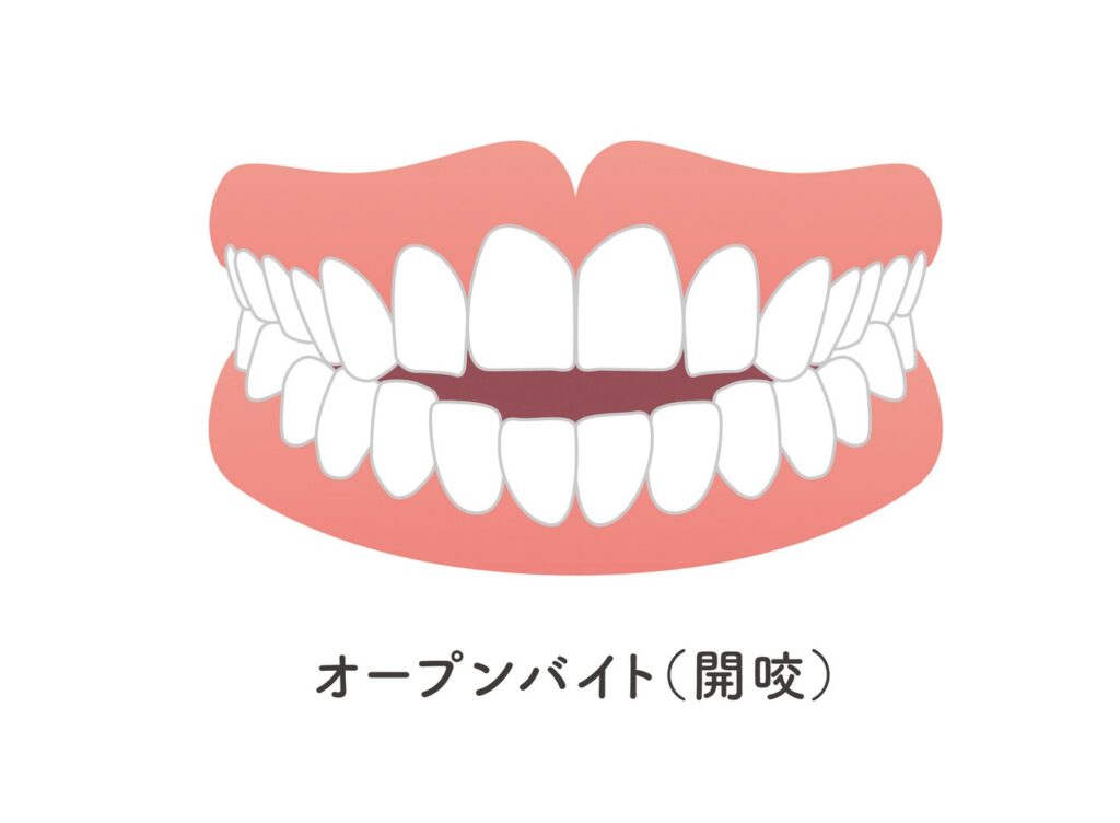 開咬（オープンバイト）のイラスト