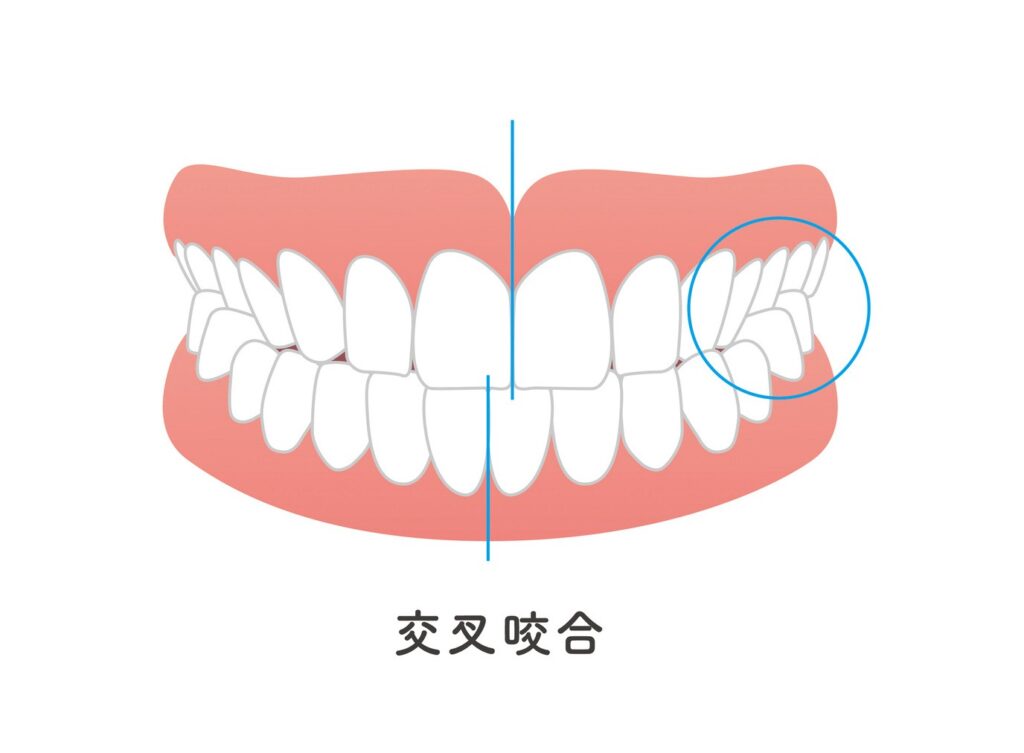 交叉咬合（クロスバイト）のイラスト