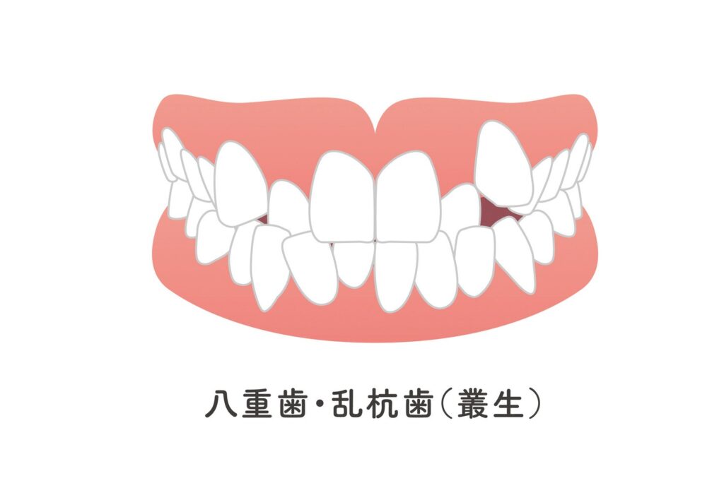 叢生（八重歯・乱杭歯・ガチャ歯）のイラスト