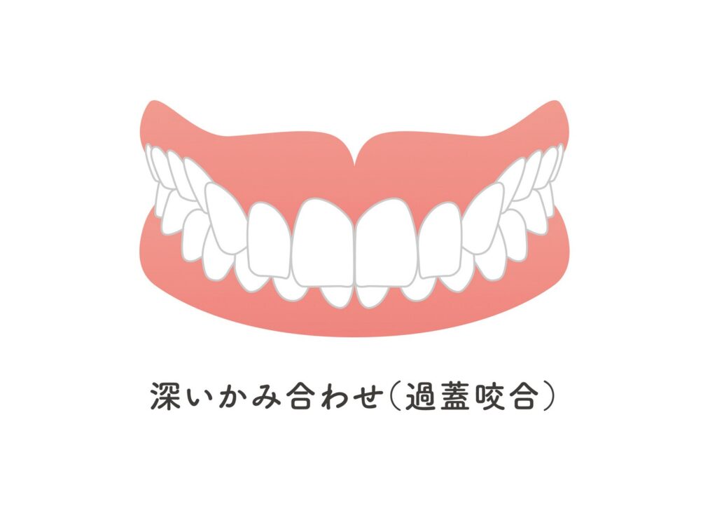 過蓋咬合（ディープバイト）のイラスト