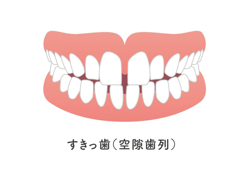 空隙歯列（すきっ歯）のイラスト