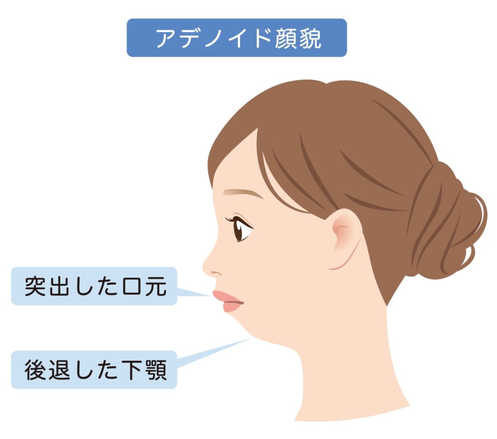 アデノイド顔貌のイラスト