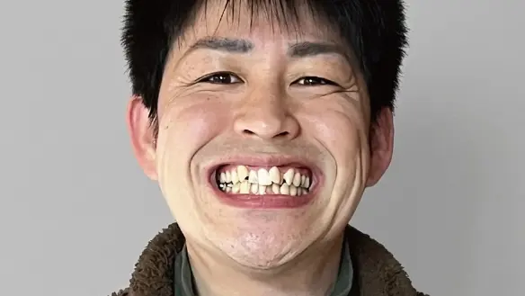 八重歯・乱杭歯（叢生）の症例（Before）