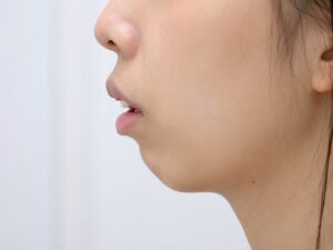 アデノイド顔貌の女性の横顔