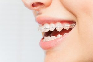 ワイヤー矯正を付けた笑顔の口元
