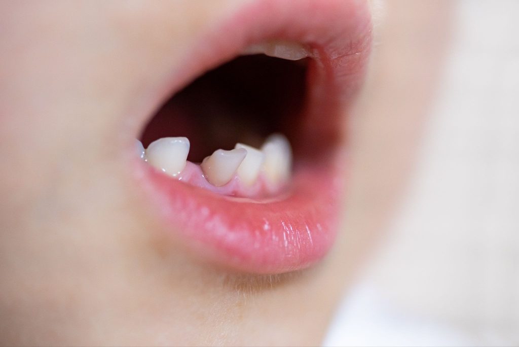 少し傾いた乳歯が生えている子供の口元