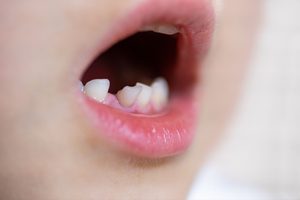 少し傾いた乳歯が生えている子供の口元