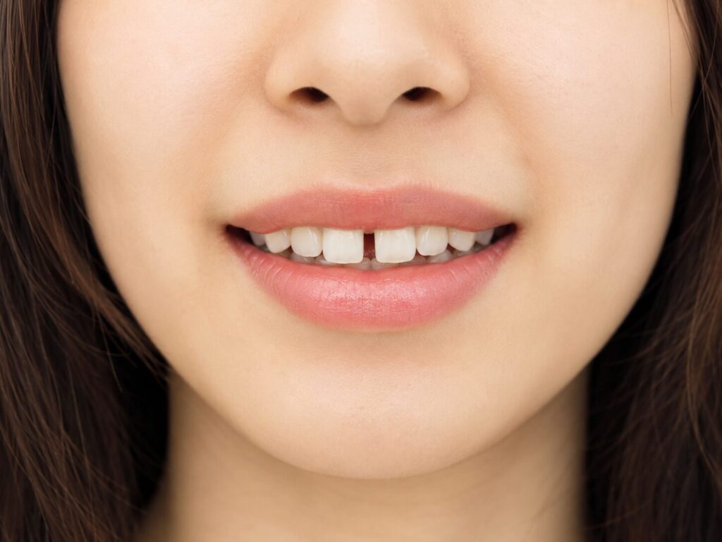 すきっ歯の女性の口元