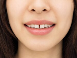 すきっ歯の女性の口元
