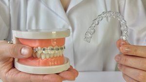 マウスピース型矯正装置とワイヤー矯正装置をはめた歯の模型